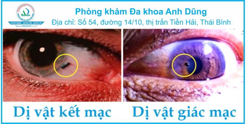 Dị vật kết giác mạc mắt: Cách xử trí khi gặp dị vật trong mắt